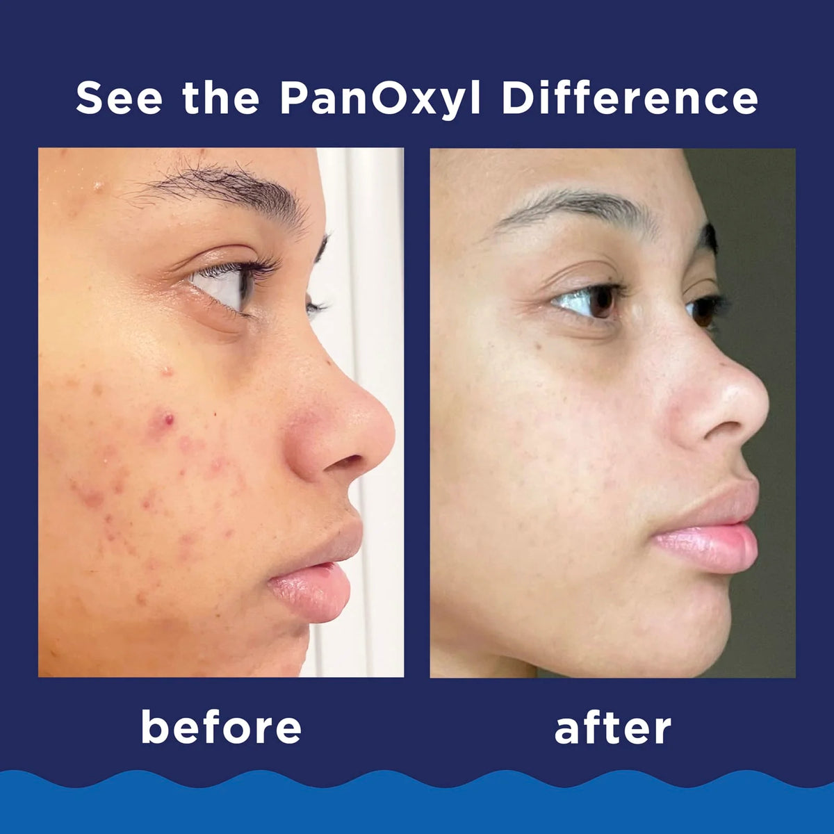 PANOXYL – Acne Foaming Wash (10% Benzoyl Peroxide)